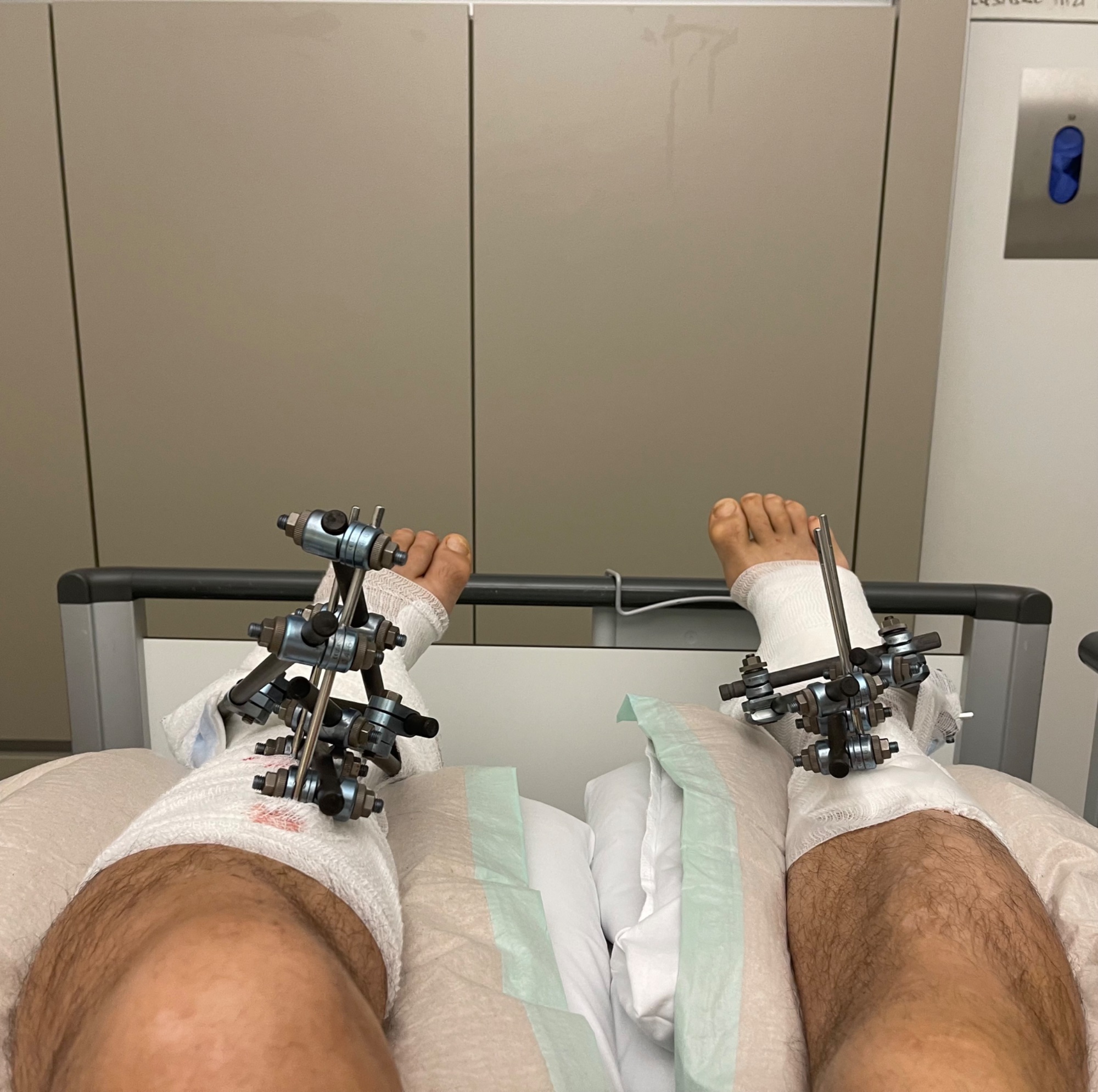 External fixators on both legs