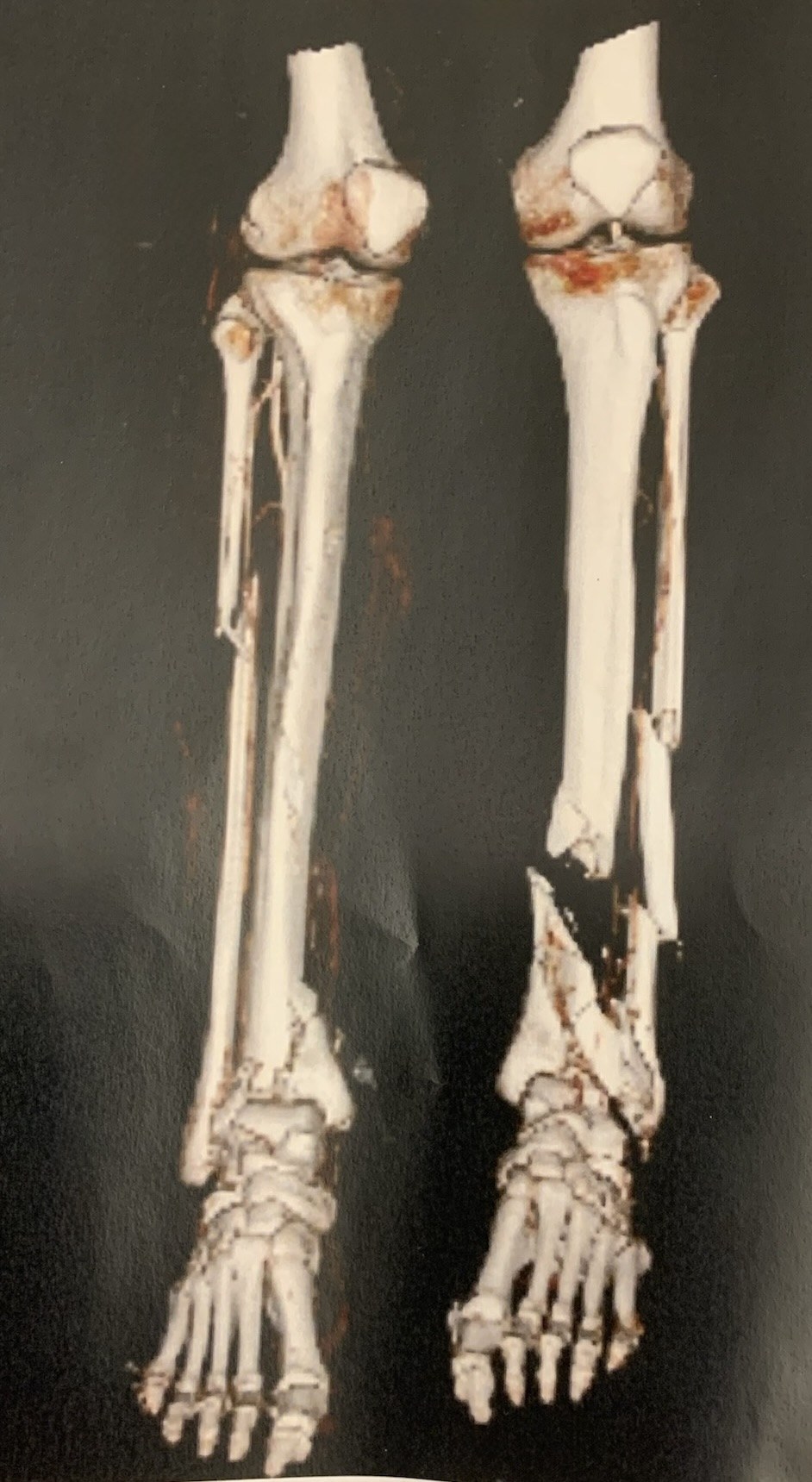 CT scan — 3D reconstruction of fractured tibia and fibula